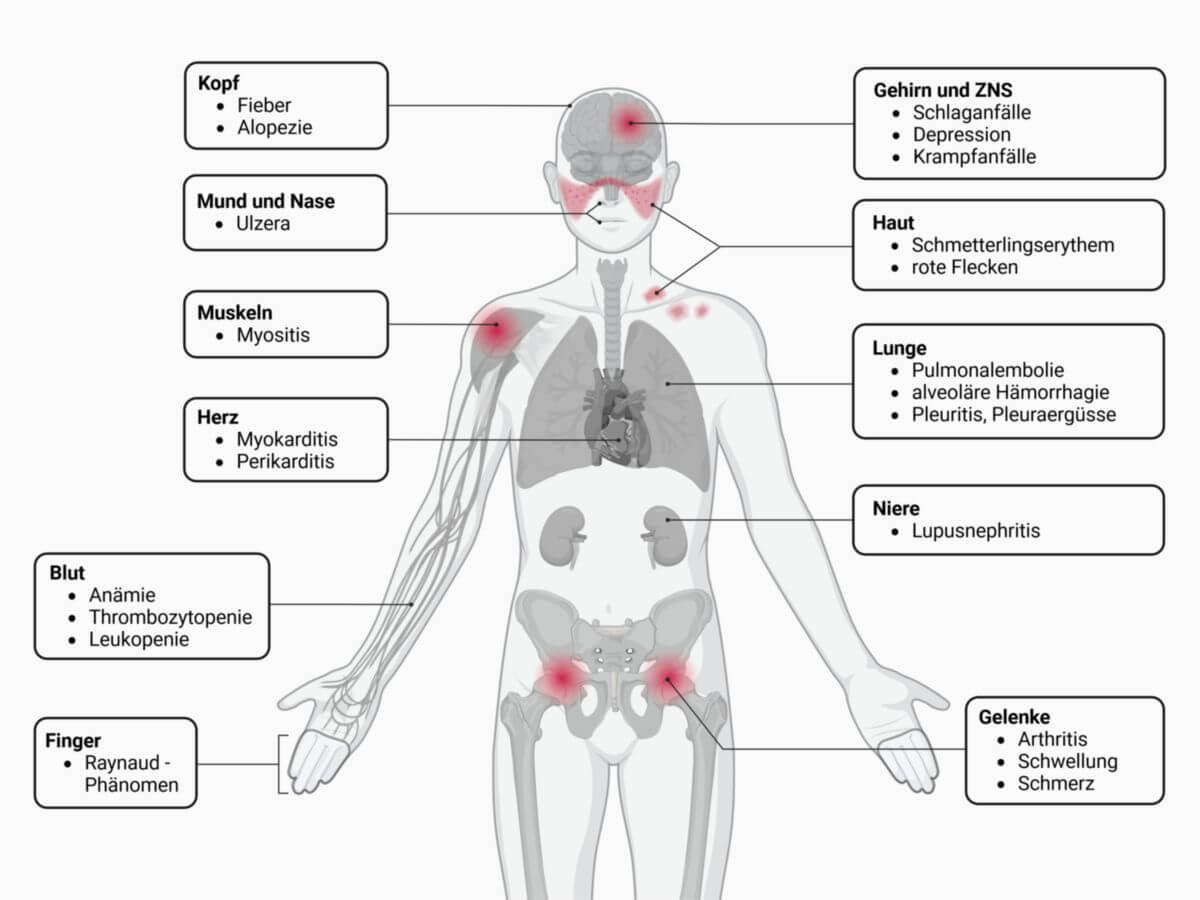 Systemischer Lupus erythematodes