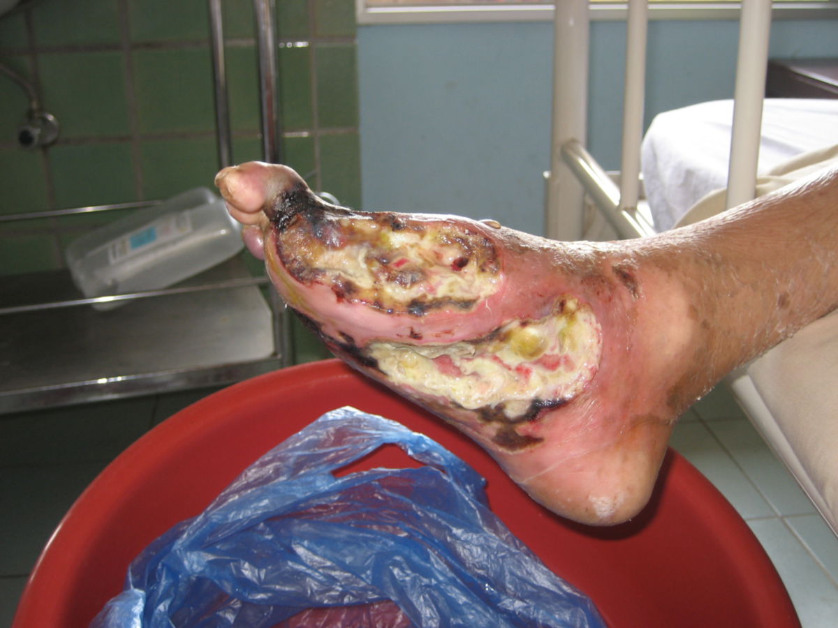 Diabetischer Fuß - Ulcus